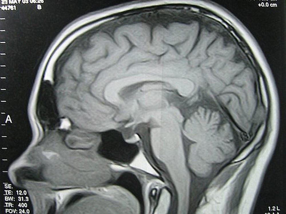 Brain MRI